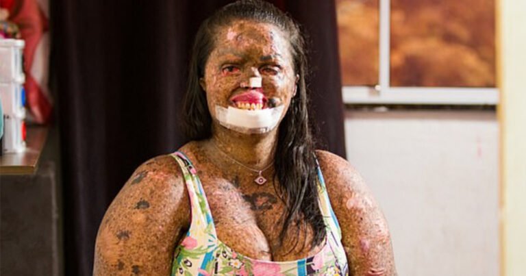 Woman with rare skin condition overcomes negativity and finds true love
